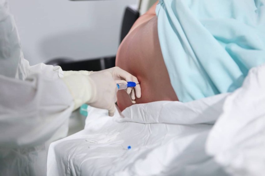 Epidurálna anestézia