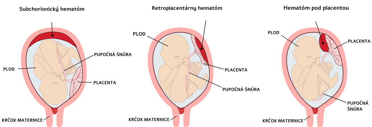 Čo je hematóm?