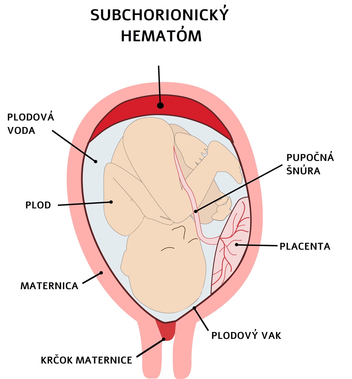 Suchorionický hematóm